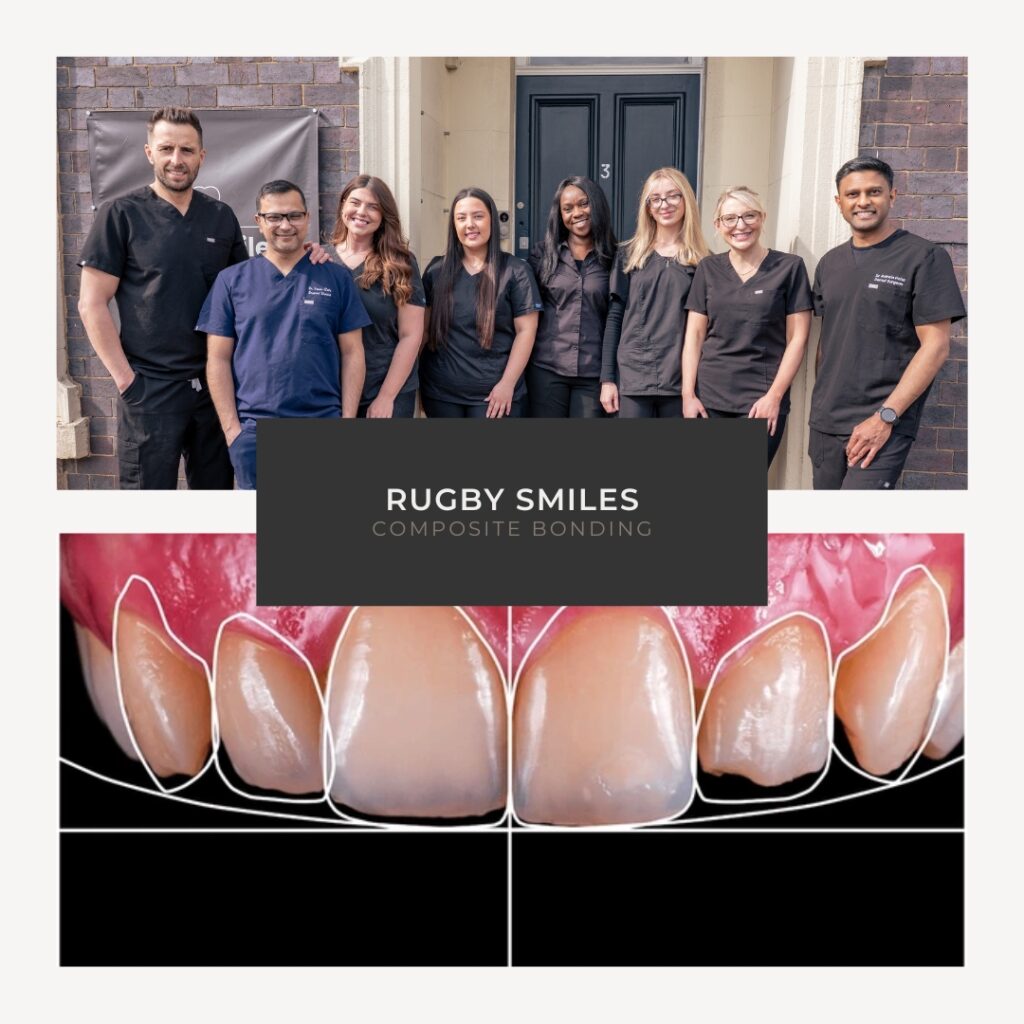 composite bonding in rugby smile design