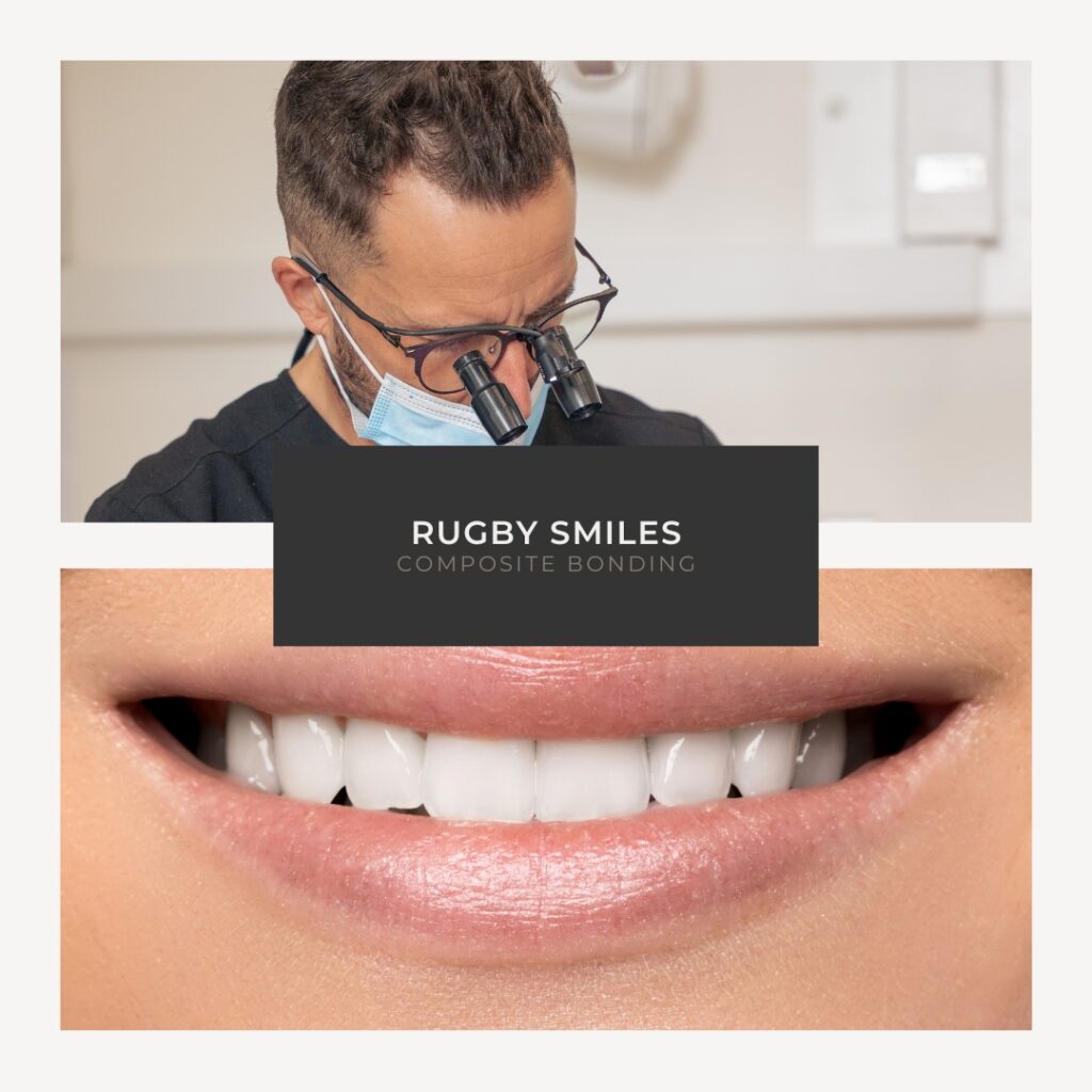 composite bonding in rugby