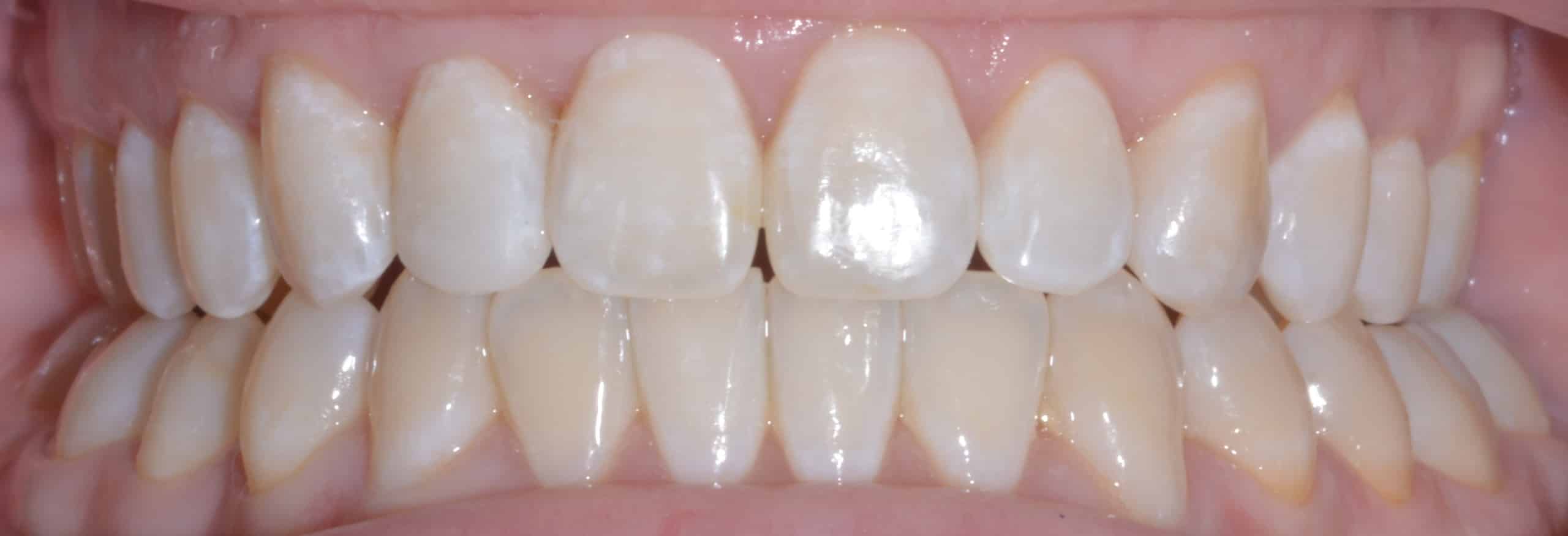 After: straightened and rebuilt smile at Rugby Smiles
