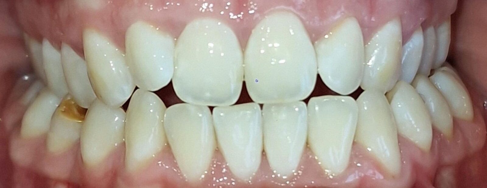 Before: crooked and worn front teeth
