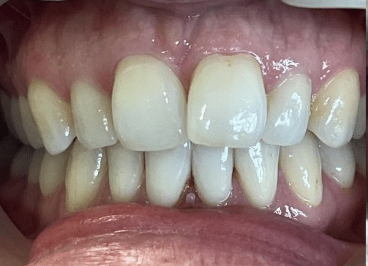 Before Invisalign treatment for crowded upper front teeth