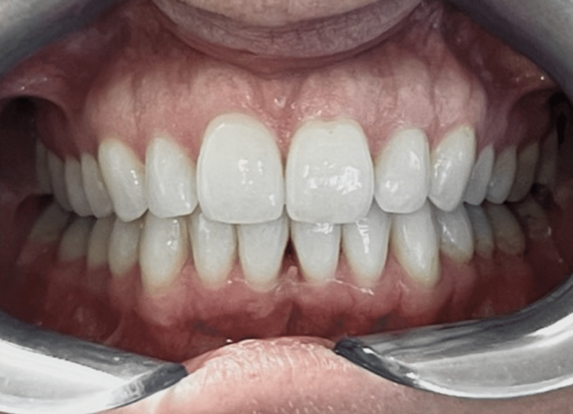 Invisalign treatment results with a straighter, more balanced smile