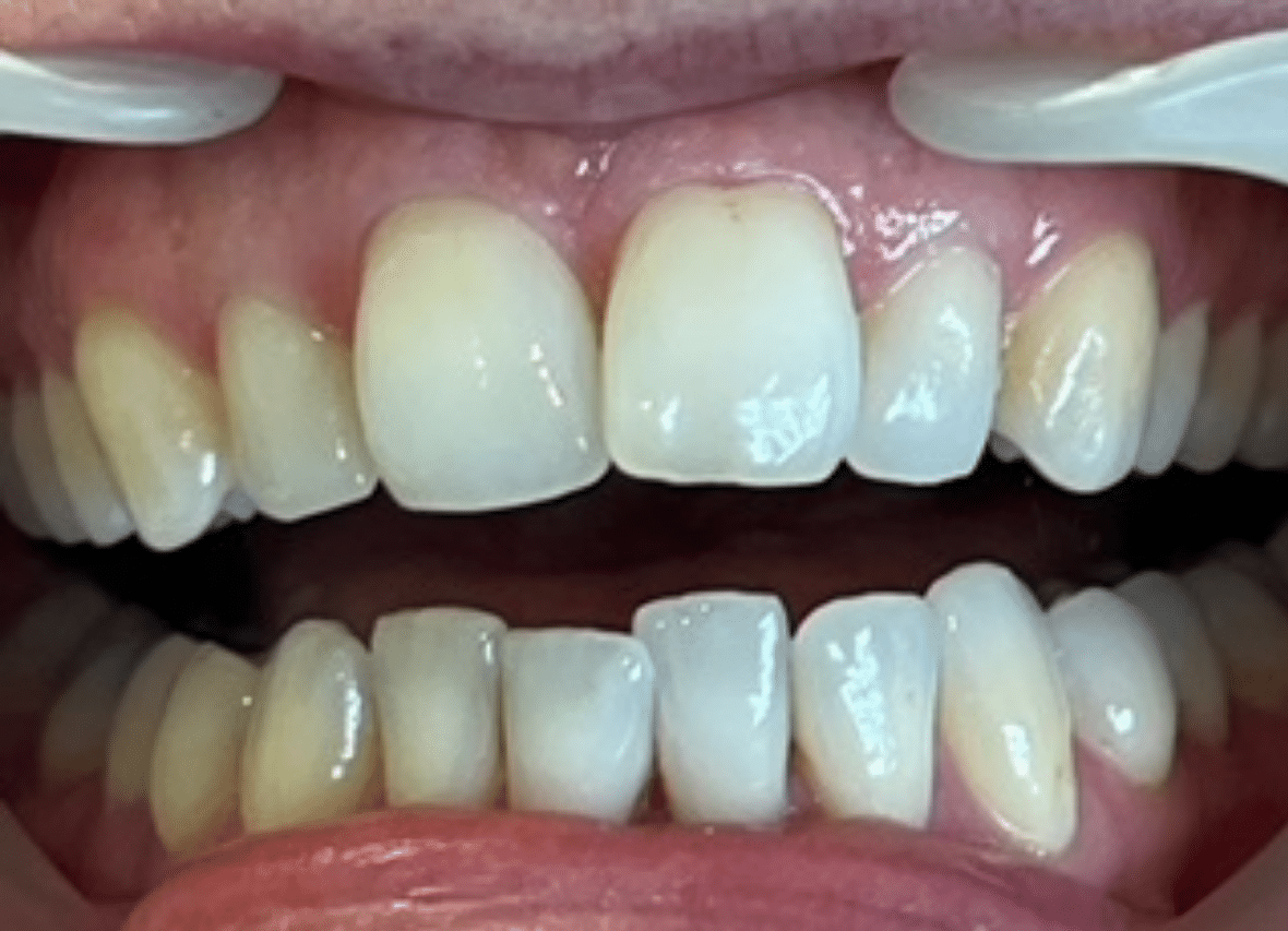 Before Invisalign treatment for crowded upper front teeth