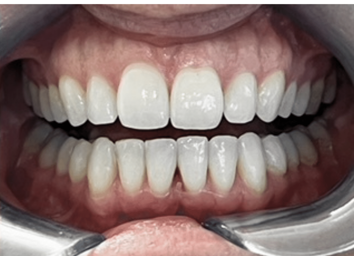 After Invisalign treatment showing straighter, more evenly aligned teeth
