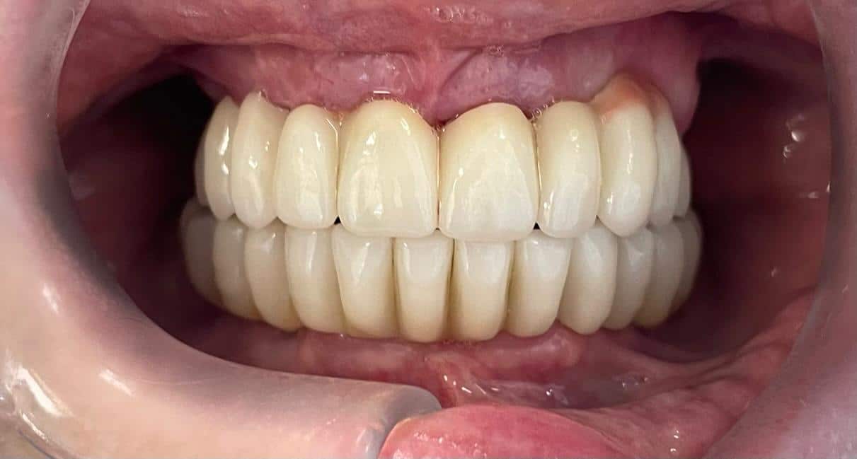After All-on-4 dental implants Rugby Smiles