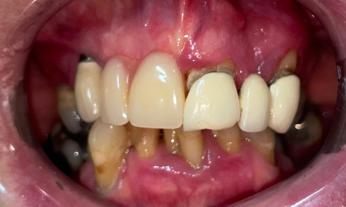 Before All-on-4 dental implants Rugby Smiles