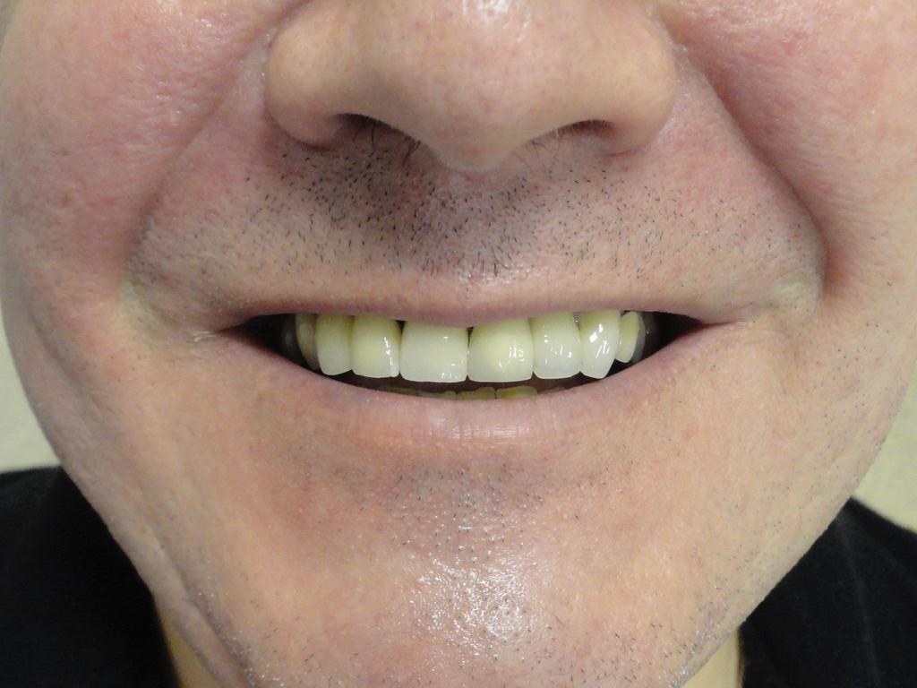 After single dental implant Rugby Smiles