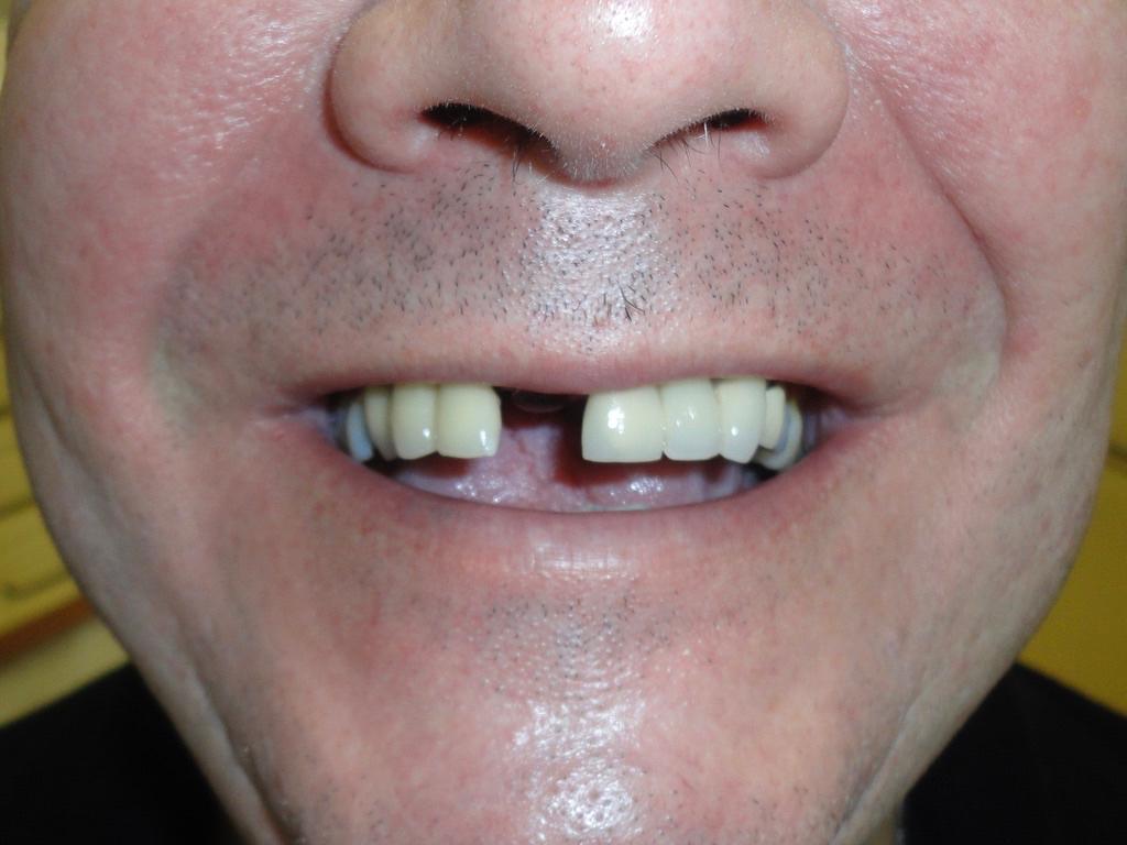 Before single dental implant Rugby Smiles