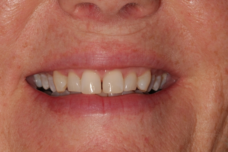 Real composite bonding result at Rugby Smiles
