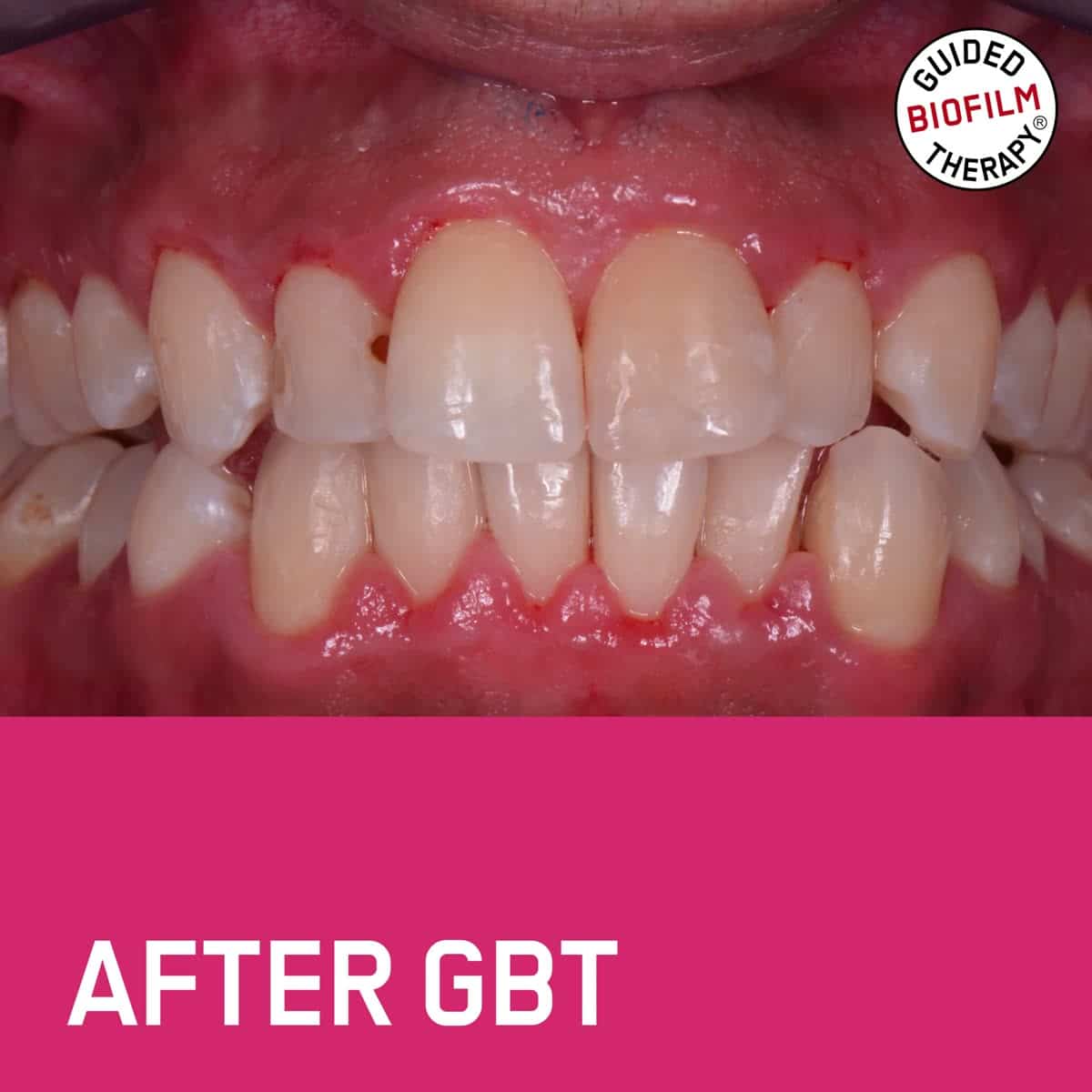 Clean, brighter teeth after a Guided Biofilm Therapy clean — example case courtesy of EMS