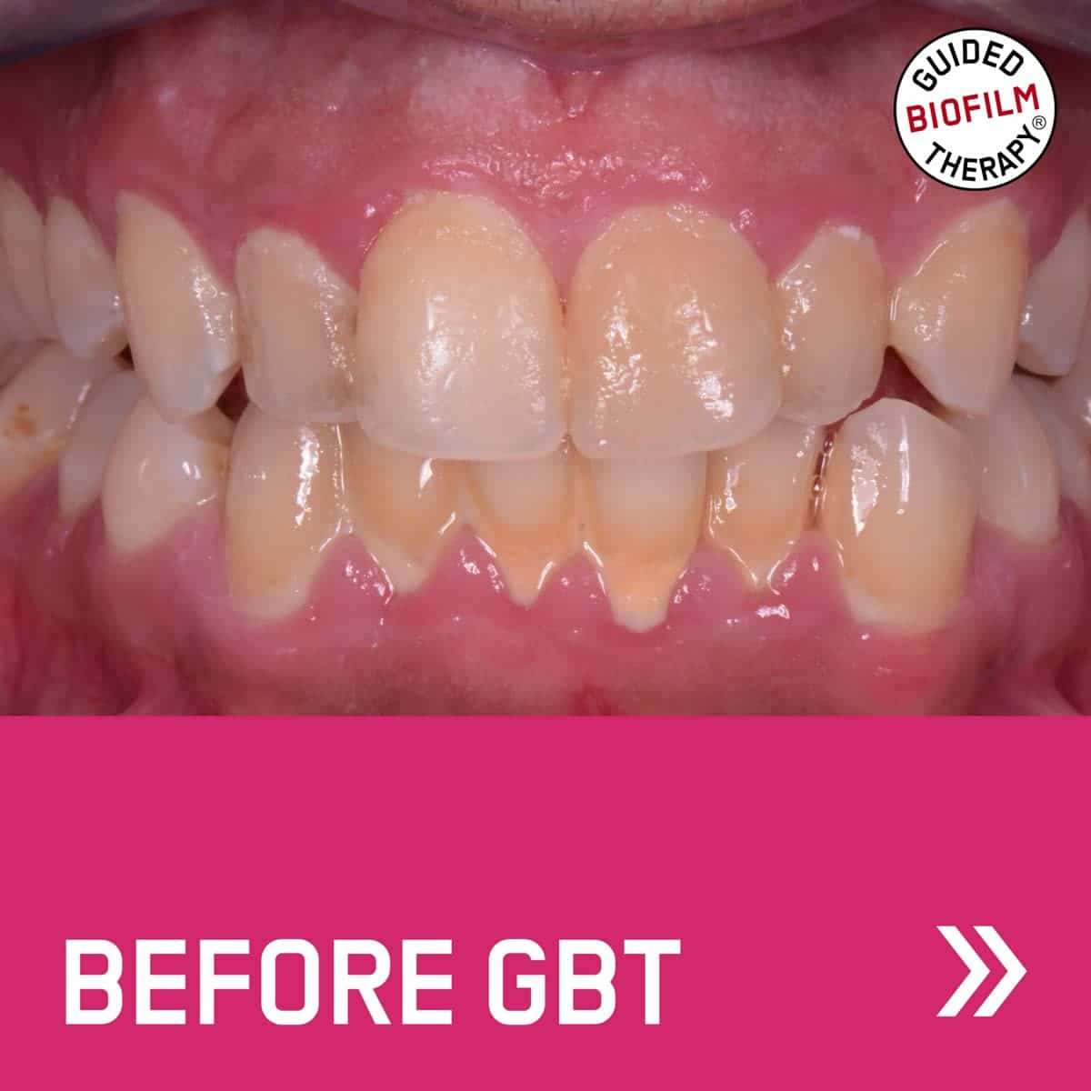 Teeth with staining and plaque before a Guided Biofilm Therapy clean — example case courtesy of EMS
