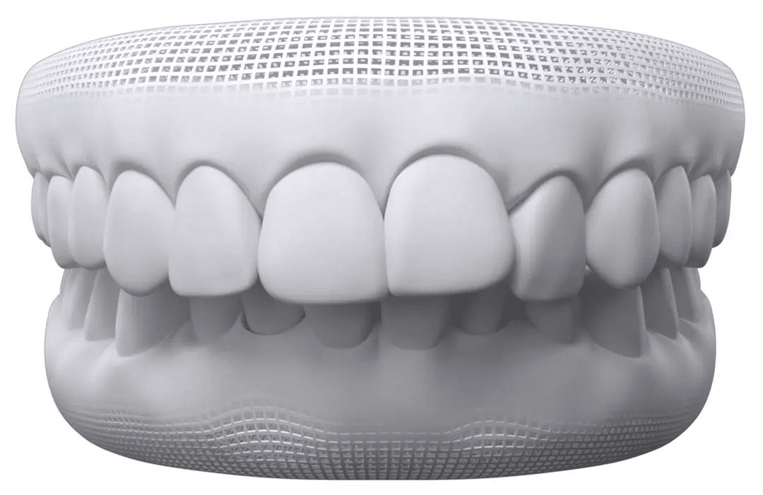 Dental model showing a deep bite