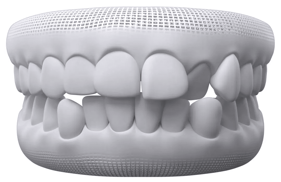 Dental model showing a crooked front tooth