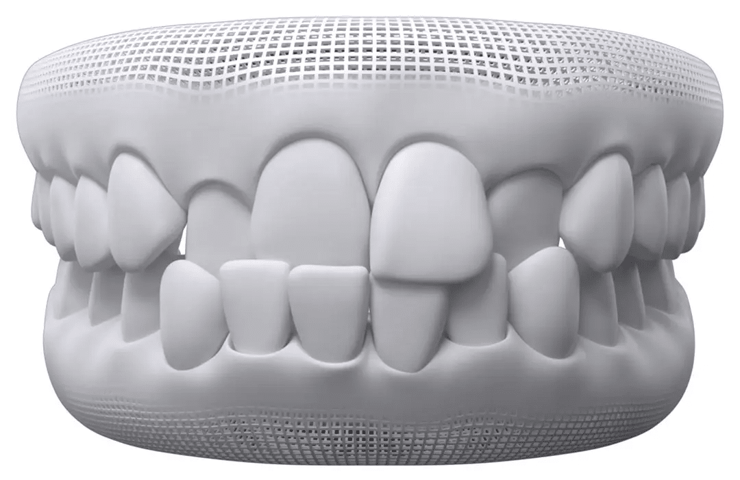 Dental model showing crowded, overlapping front teeth