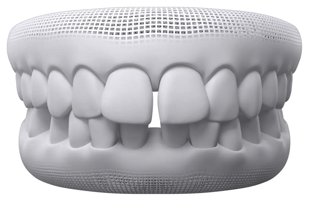Dental model showing a gap between the front teeth