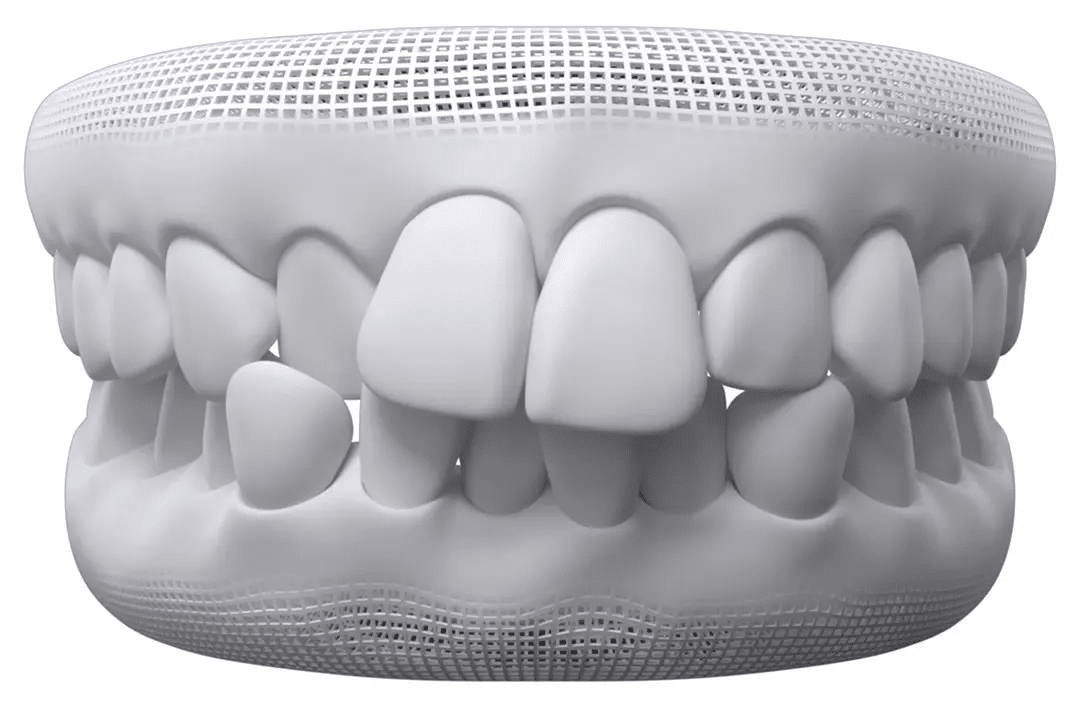Dental model showing teeth that have moved after braces